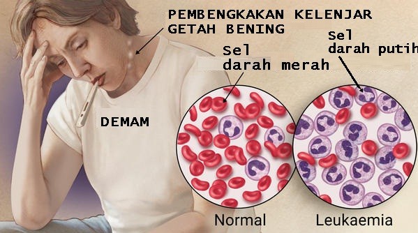 Penyakit Leukemia dan Gejalanya