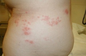 Penyakit Herpes di Bagian Perut Samping
